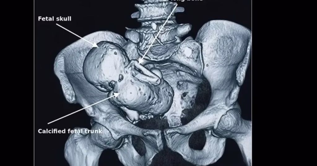 Mujer descubrió que llevaba un “bebé de piedra” tras consultar por persistentes dolores abdominales